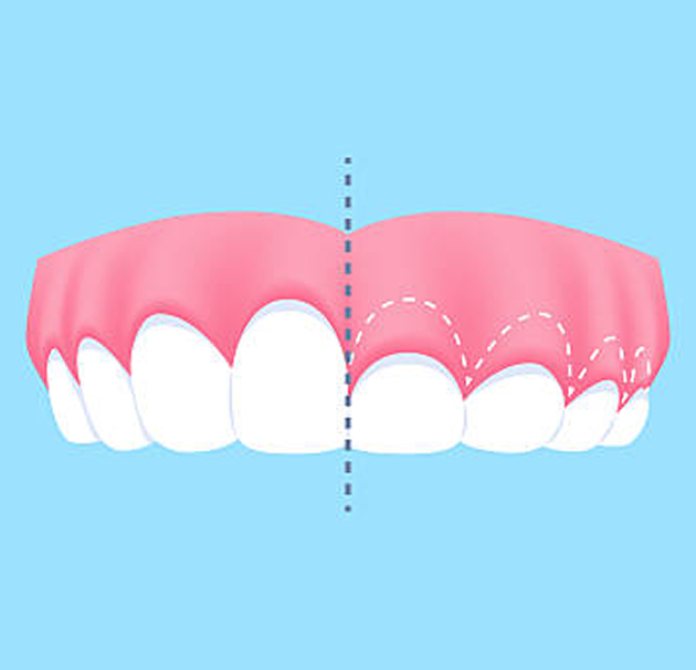 Pinhole Surgical Technique